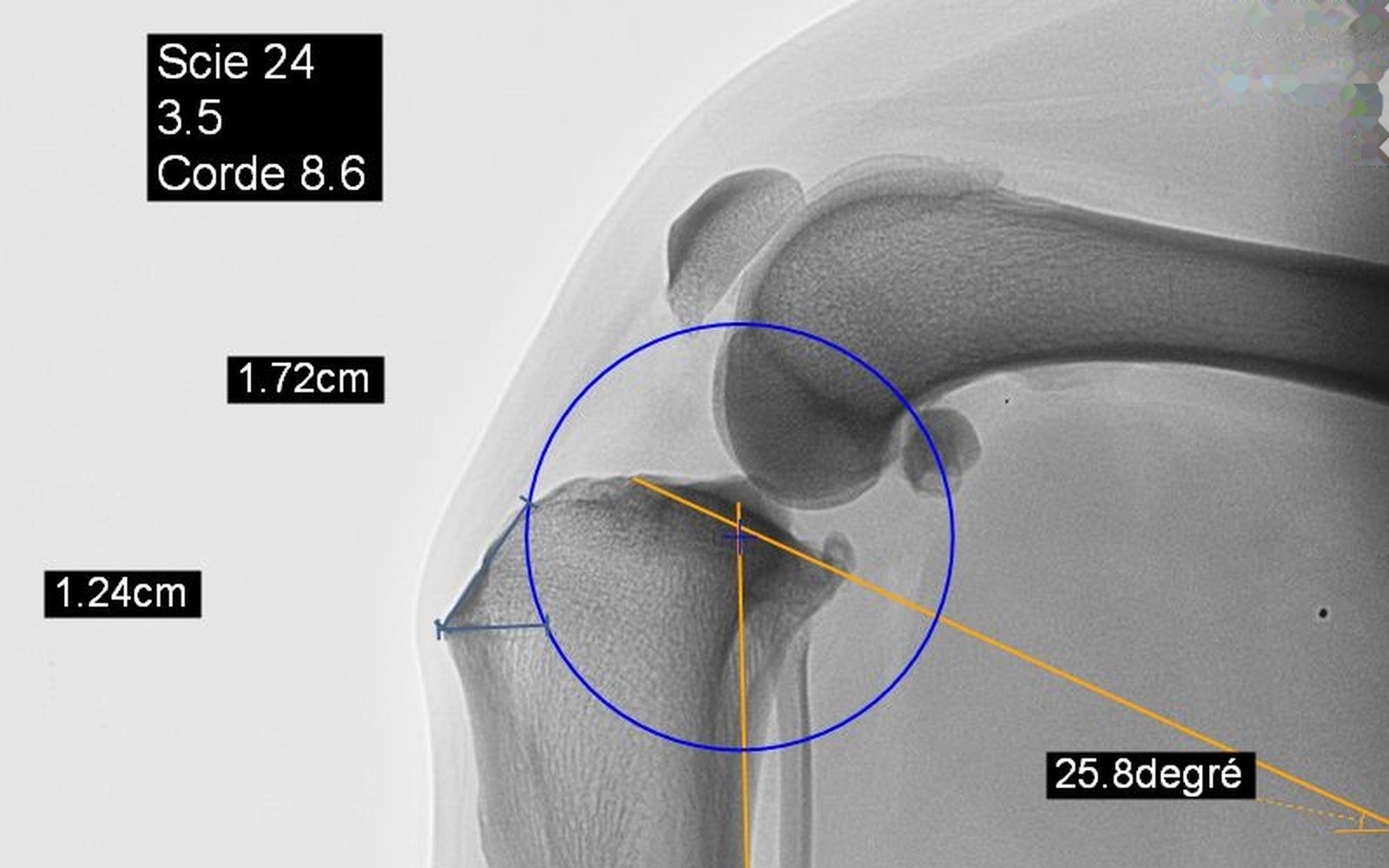 Radiographie orthopédique : planification d'une chirurgie articulaire